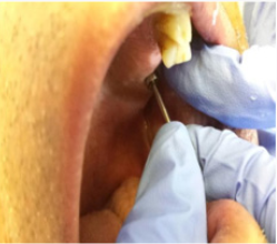 Advances in Dentistry and Oral Health (ADOH) | Juniper Publishers