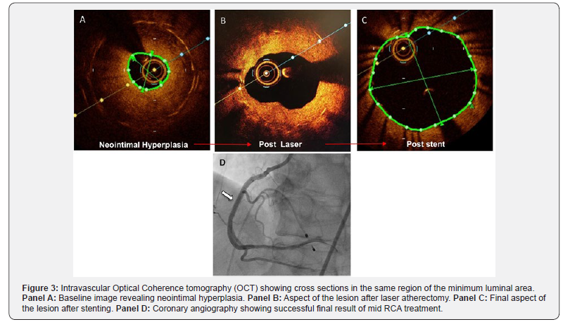 Click here to view Large Figure 3 Journal of Cardiology & Cardiovascular Therapy