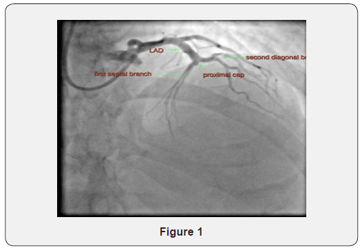 Click here to view Large Figure 1 Journal of Cardiology & Cardiovascular Therapy