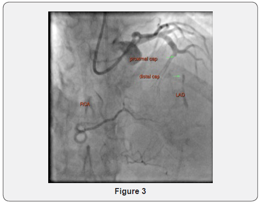 Click here to view Large Figure 3 Journal of Cardiology & Cardiovascular Therapy