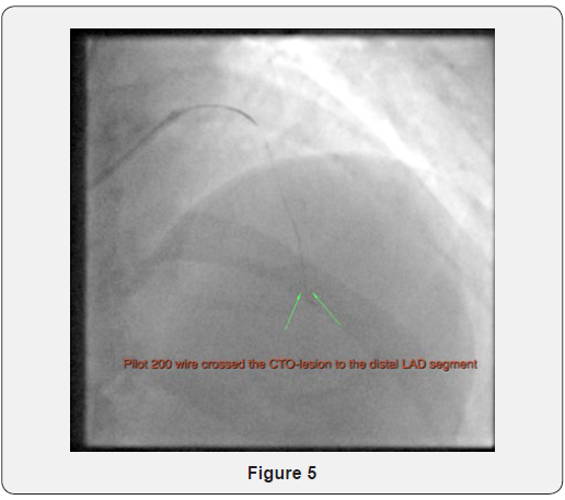 Click here to view Large Figure 5 Journal of Cardiology & Cardiovascular Therapy