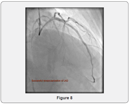Click here to view Large Figure 8 Journal of Cardiology & Cardiovascular Therapy