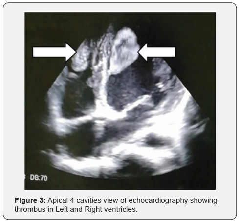 Click here to view Large Figure 3 Journal of Cardiology & Cardiovascular Therapy