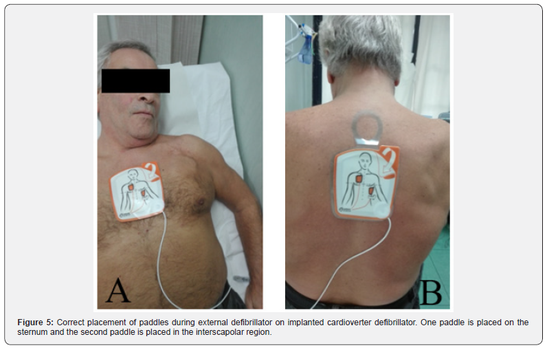 Click here to view Large Figure 5 Journal of Cardiology & Cardiovascular Therapy