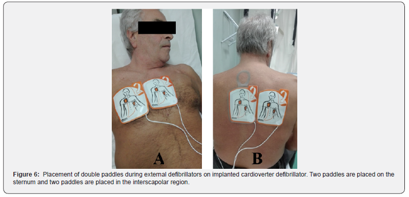 Click here to view Large Figure 6 Journal of Cardiology & Cardiovascular Therapy