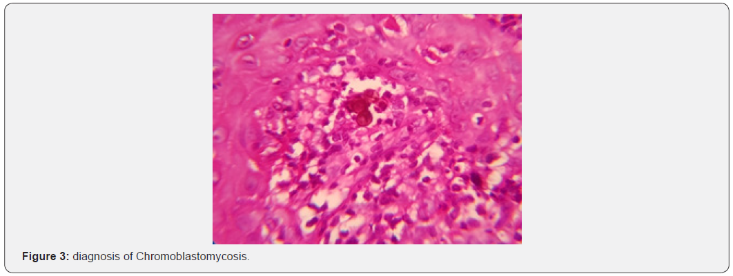 Click here to view Large Figure 3 JOJ Dermatology & Cosmetics