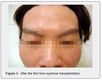 Click here to view Large Figure 5 JOJ Dermatology & Cosmetics