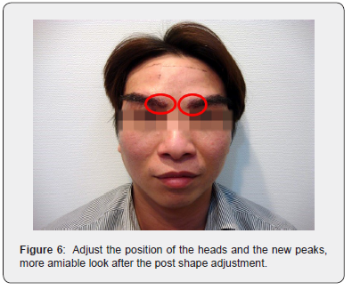 Click here to view Large Figure 6 JOJ Dermatology & Cosmetics