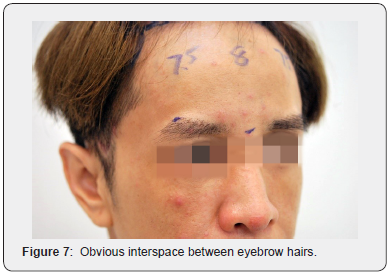 Click here to view Large Figure 7 JOJ Dermatology & Cosmetics