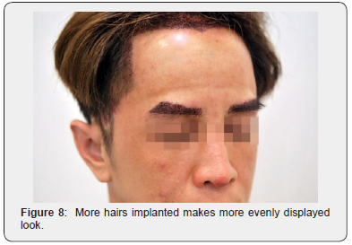 Click here to view Large Figure 8 JOJ Dermatology & Cosmetics