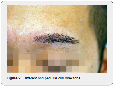 Click here to view Large Figure 9 JOJ Dermatology & Cosmetics
