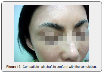 Click here to view Large Figure 12 JOJ Dermatology & Cosmetics