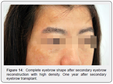 Click here to view Large Figure 14 JOJ Dermatology & Cosmetics