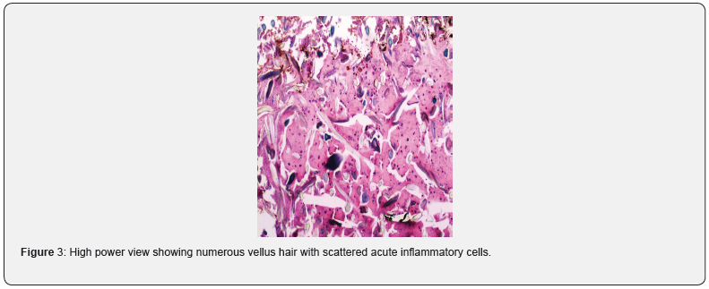 Click here to view Large Figure 3 JOJ Dermatology & Cosmetics