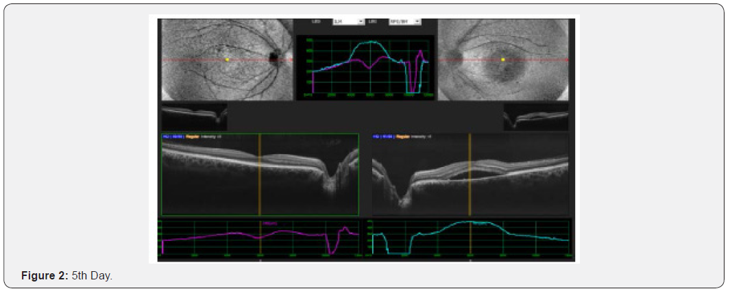 Click here to view Large Figure 2 JOJ Ophthalmology