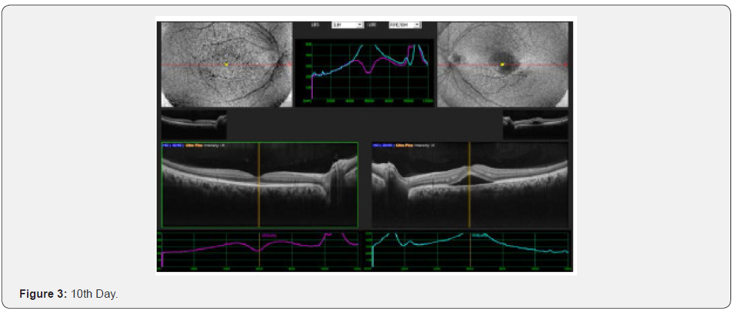 Click here to view Large Figure 3 JOJ Ophthalmology
