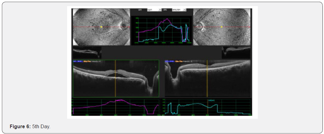 Click here to view Large Figure 6 JOJ Ophthalmology