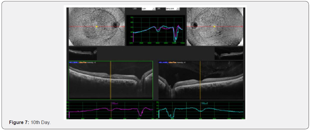 Click here to view Large Figure 7 JOJ Ophthalmology