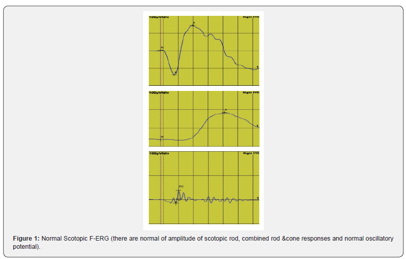 Click here to view Large Figure 1 JOJ Ophthalmology