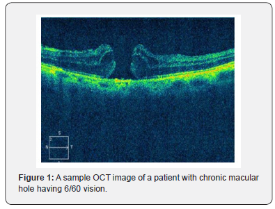 Click here to view Large Figure 1 JOJ Ophthalmology