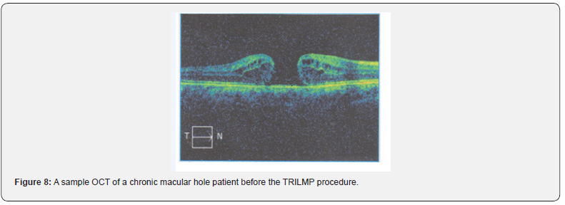 Click here to view Large Figure 8 JOJ Ophthalmology