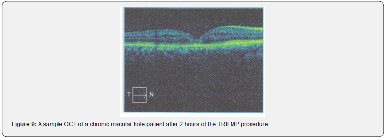 Click here to view Large Figure 9 JOJ Ophthalmology