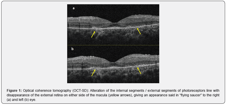 Click here to view Large Figure 1 JOJ Ophthalmology