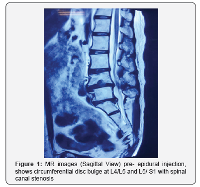 Click here to view Large Figure 1 Juniper Online Journal of Orthopedic & Orthoplastic Surgery