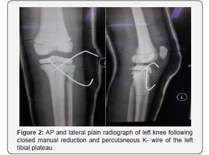 Click here to view Large Figure 2 Juniper Online Journal of Orthopedic & Orthoplastic Surgery