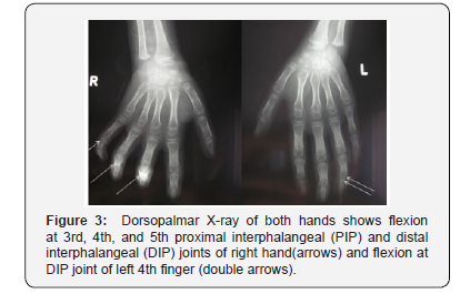 Click here to view Large Figure 3 Juniper Online Journal of Orthopedic & Orthoplastic Surgery