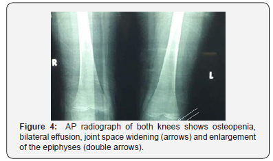 Click here to view Large Figure 4 Juniper Online Journal of Orthopedic & Orthoplastic Surgery