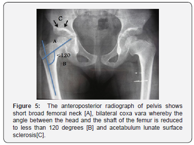 Click here to view Large Figure 5 Juniper Online Journal of Orthopedic & Orthoplastic Surgery