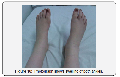 Click here to view Large Figure 10 Juniper Online Journal of Orthopedic & Orthoplastic Surgery