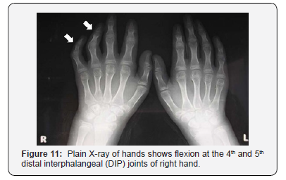 Click here to view Large Figure 11 Juniper Online Journal of Orthopedic & Orthoplastic Surgery