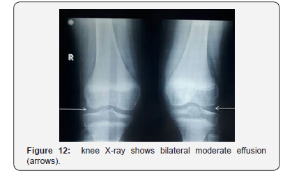 Click here to view Large Figure 12 Juniper Online Journal of Orthopedic & Orthoplastic Surgery