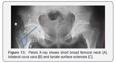 Click here to view Large Figure 13 Juniper Online Journal of Orthopedic & Orthoplastic Surgery