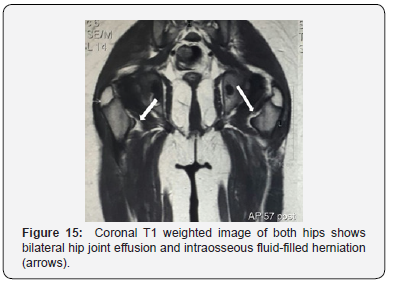 Click here to view Large Figure 15 Juniper Online Journal of Orthopedic & Orthoplastic Surgery