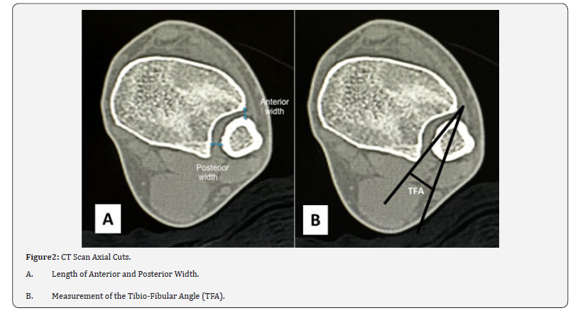 Click here to view Large Figure 2 Juniper Online Journal of Orthopedic & Orthoplastic Surgery