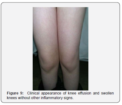 Click here to view Large Figure 9 Juniper Online Journal of Orthopedic & Orthoplastic Surgery