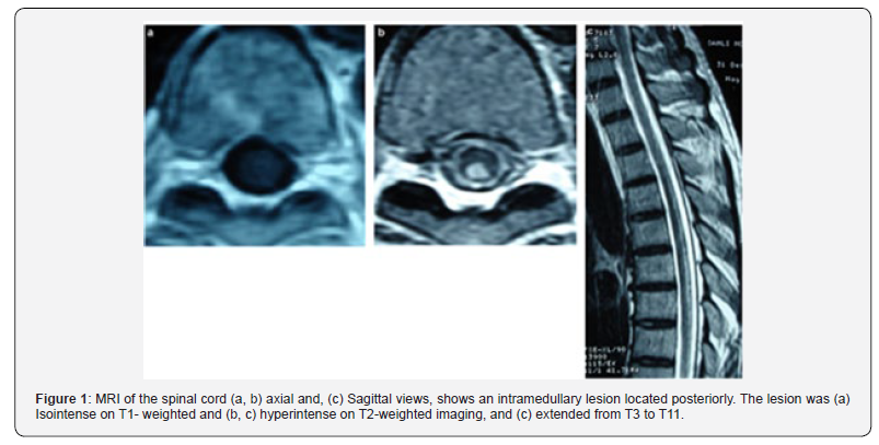 Click here to view Large Figure 1 Open Access Journal of Neurology & Neurosurgery