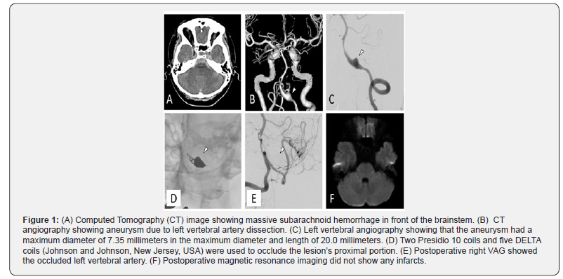 Click here to view Large Figure 1 Open Access Journal of Neurology & Neurosurgery