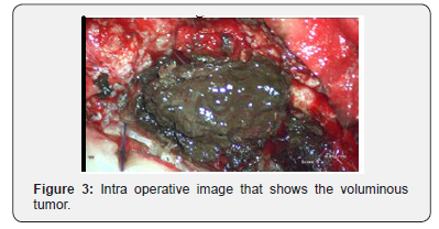 Click here to view Large Figure 3 Open Access Journal of Neurology & Neurosurgery