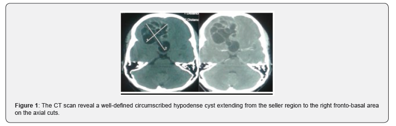 Click here to view Large Figure 1 Open Access Journal of Neurology & Neurosurgery