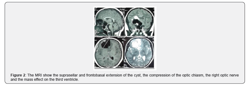 Click here to view Large Figure 2 Open Access Journal of Neurology & Neurosurgery