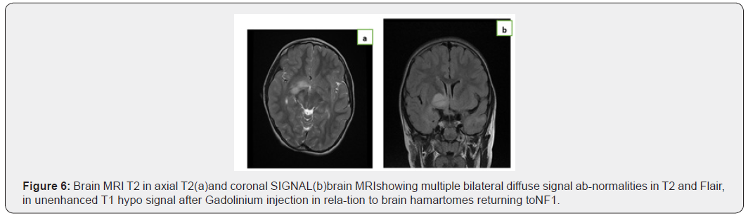 Click here to view Large Figure 6 Open Access Journal of Neurology & Neurosurgery