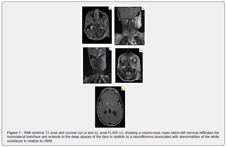 Click here to view Large Figure 7 Open Access Journal of Neurology & Neurosurgery