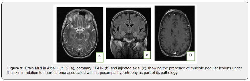 Click here to view Large Figure 9 Open Access Journal of Neurology & Neurosurgery