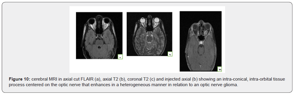 Click here to view Large Figure 10 Open Access Journal of Neurology & Neurosurgery