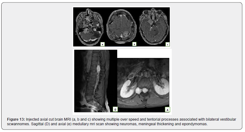 Click here to view Large Figure 13 Open Access Journal of Neurology & Neurosurgery