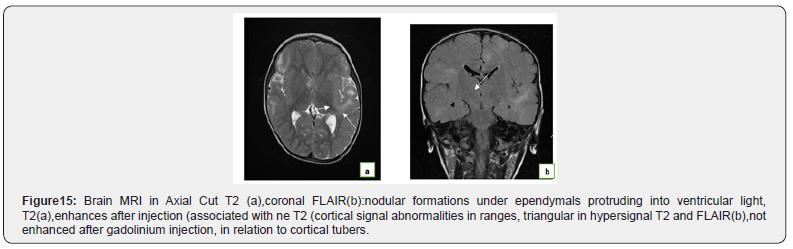 Click here to view Large Figure 15 Open Access Journal of Neurology & Neurosurgery